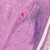 炎症性筋線維芽細胞性腫瘍